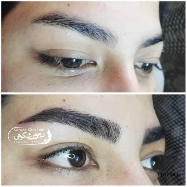 فیبروز ابرو - فیبروز ابرو.هاشورمویی،سایه ابرو،اسکالپ سر - آرایشی، پزشکی - آرایشی پزشکی بانوان - Brow-fibrosis