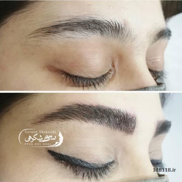 فیبروز ابرو - فیبروز ابرو.هاشورمویی،سایه ابرو،اسکالپ سر - آرایشی، پزشکی - آرایشی پزشکی بانوان - Brow-fibrosis