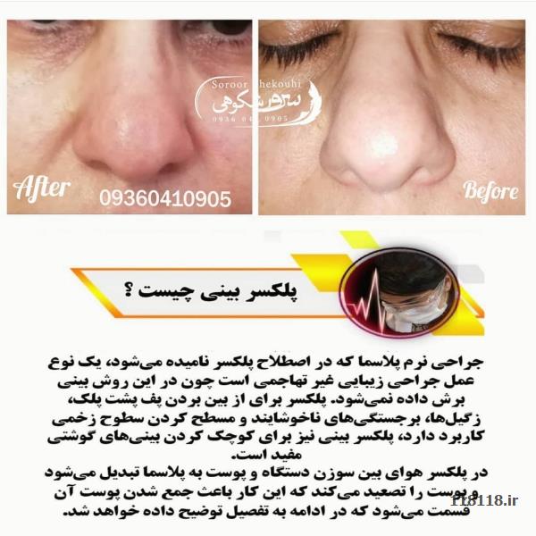 فیبروز ابرو.هاشورمویی،سایه ابرو،اسکالپ سر