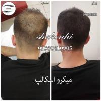 فیبروز ابرو.هاشورمویی،سایه ابرو،اسکالپ سر