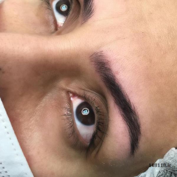 فیبروز، میکروپیگمنتیشن صورت و ریموو