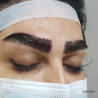 کاشت ابرو تخصصی