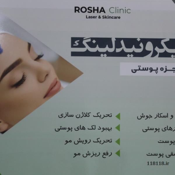 لیزر موهای زاید